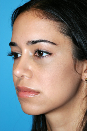 Richard Davis, MD Revision Rhinoplasty: Patient 6, Oblique View, Post-Op