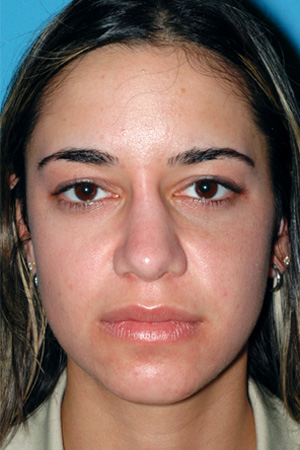 Richard Davis, MD Revision Rhinoplasty: Patient 6, Front View, Pre-Op