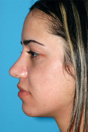 Richard Davis, MD Revision Rhinoplasty: Patient 6, Profile View, Pre-Op