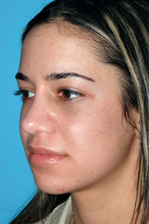 Richard Davis, MD Revision Rhinoplasty: Patient 6, Oblique View, Pre-Op