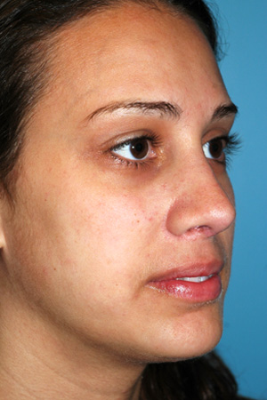 Richard Davis, MD Revision Rhinoplasty: Patient 7, Oblique View, Post-Op