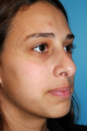 Richard Davis, MD Revision Rhinoplasty: Patient 7, Oblique View, Pre-Op