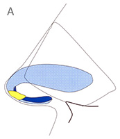 Intermediate Crura - Profile View