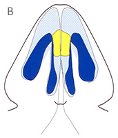 Intermediate Crura - Base View