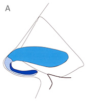 Lateral Crura - Profile View