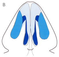 Lateral Crura - Base View