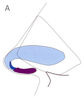 Medial Crura - Profile View