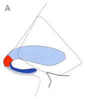 Nasal Domes - Profile View