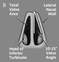 Partial Obstruction by Inferior Turbinate Head