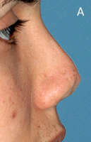 Nasal Valve Area