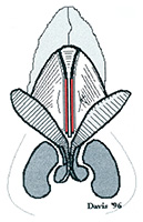 Bilateral Spreader Graft