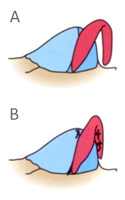 Tongue-in-Groove Setback Procedure