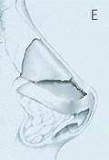 Over-rotated Tip (Pig Nose) after Aggressive Cephalic Trim