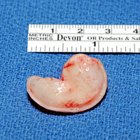 Harvested Conchal (Ear) Cartilage