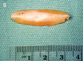 Harvested Costal (Rib) Cartilage After Carving